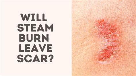 Will Steam Burn Leave Scar? - Treat Your Scars