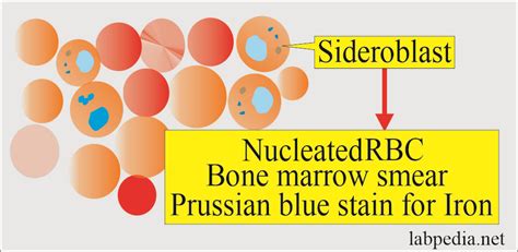 Anemia:- Part 9 - Sideroblastic Anemia, and Anemia Due To Chronic Diseases - Labpedia.net