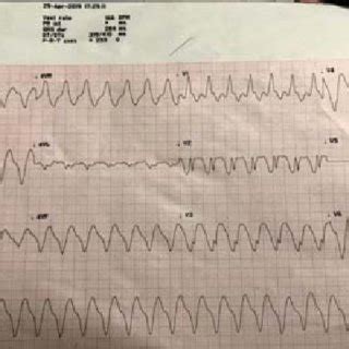 ECG dated 29 April showing monomorphic VT. | Download Scientific Diagram