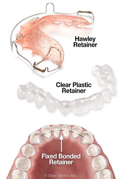 Retention | Palmieri Orthodontics | Rockville Centre New York