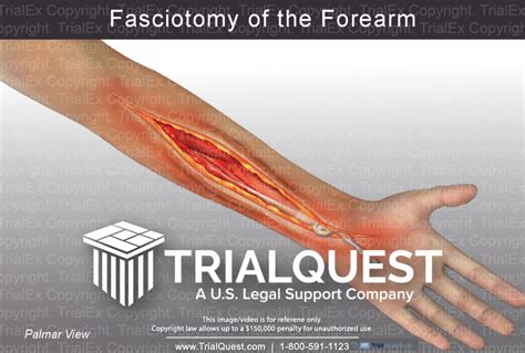 Fasciotomy of the Forearm - TrialExhibits Inc.