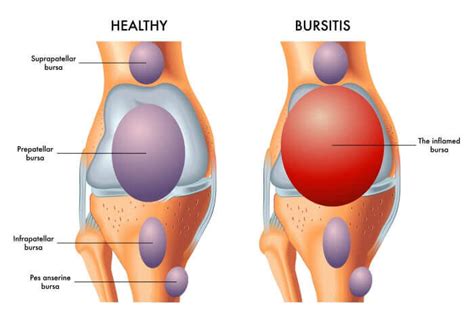 Is My Joint Pain Arthritis or BURSITIS? - Towson Orthopaedic Associates