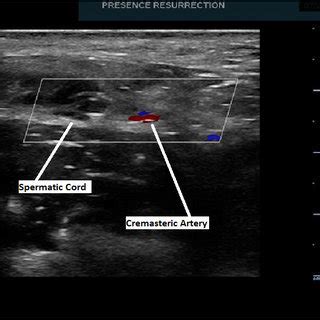 Spermatic Cord Anatomy Diagram