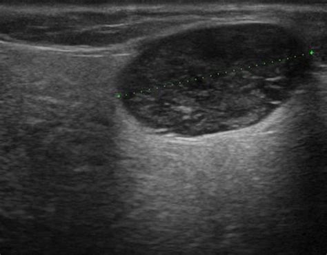 Head and Neck | 4.3 Salivary glands : Case 4.3.4 Warthin's tumors | Ultrasound Cases