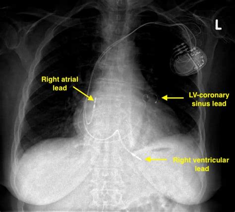 Pacemaker terminology - Questions and Answers in MRI