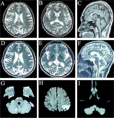 Intraparietal Sulcus Mri