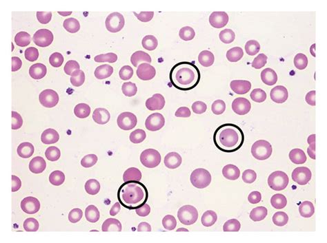 Peripheral blood smear (1000x oil, magnification): normocytic ...