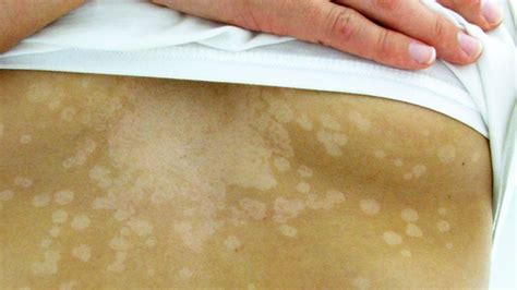 Tinea Versicolor: cause, sintomi e trattamento - Uno stile di vita sano