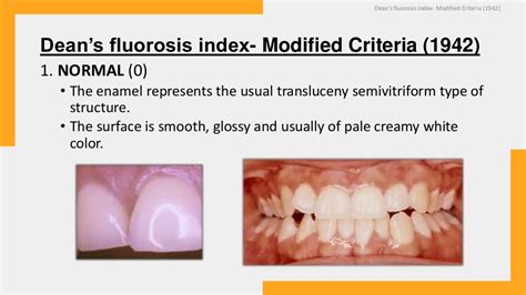 DEAN’S FLUOROSIS INDEX 1943 (PUBLIC HEALTH DENTISTRY)