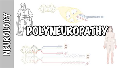 Approach to Polyneuropathy - causes, pathophysiology, investigations ...