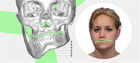 Asymmetrical Jaw & Chin: Causes and How to Fix it Naturally | Mewing.coach