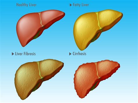 New System Detects Cirrhosis in Fatty Liver Disease