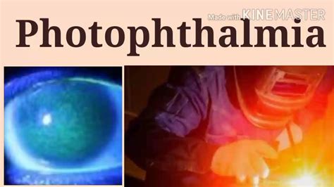 Photophthalmia | photophthalmia treatment | photokeratitis ...