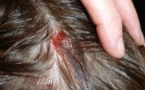 Sores on scalp are common during the summer season, however they may also occur… | Kepek, Saç