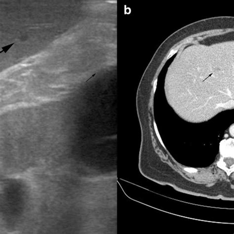 a Intraoperative ultrasound of the male patient with a hepatic lesion... | Download Scientific ...