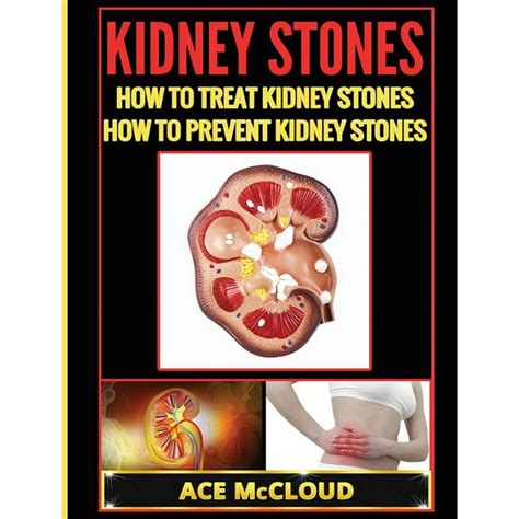 Kidney Stone Treatment & Prevention Guide with All: Kidney Stones : How To Treat Kidney Stones ...