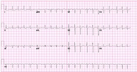 Atrial Flutter - Causes, Symptoms, Treatment & Ablation