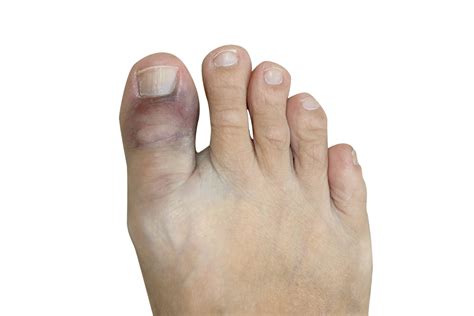 Do You Have a Broken Toe? | Triad Foot & Ankle Center