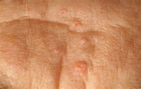 Sebaceous Glands - Pictures, Function, Types, Location | HubPages