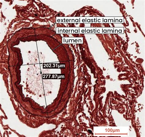 Portal Hypertension Histology