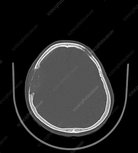 Bone metastasis, CT scan - Stock Image - F039/3306 - Science Photo Library