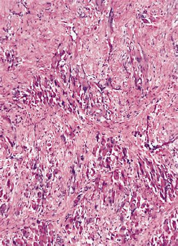 Pathology Outlines - Fibromatosis colli