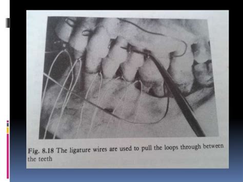 Various intermaxillary fixation techniques