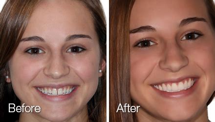 How To Make Veneers Look Natural - Babin Forintolue