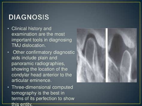 Temporomandibular joint dislocation