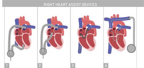 Right heart assist devices: (1) right ventricular assist device with ...