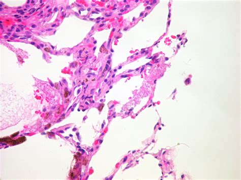 Pneumocystis pneumonia with minimal findings Case 212 | Flickr