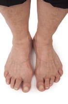 Rheumatoid Arthritis Foot Deformity