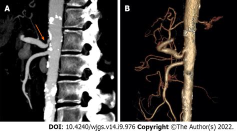 Arcuate Ligament Syndrome