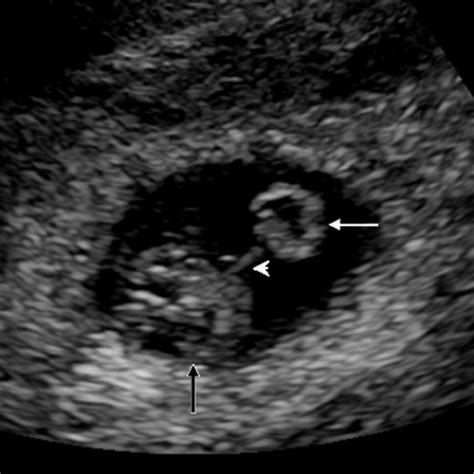 Yolk Sac 6 Weeks Ultrasound