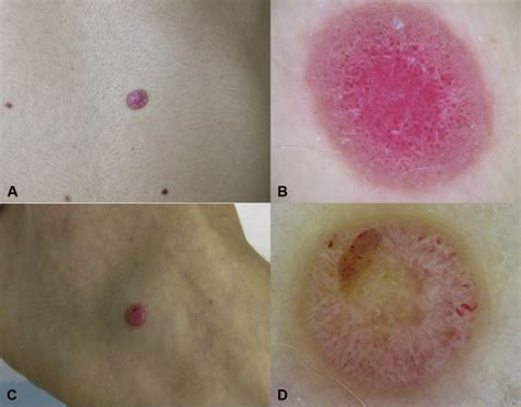 Clinical and dermoscopic features of atypical Spitz tumors: A multicenter, retrospective, case ...