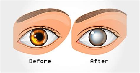 Common Eye Disorders- Symptoms And Treatment