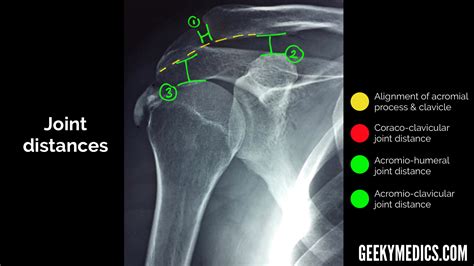 Shoulder X-ray Interpretation | Radiology | Geeky Medics