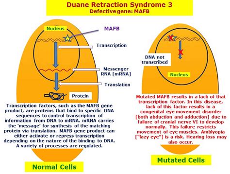 Duane syndrome, Duane Retraction syndrome causes, diagnosis & treatment