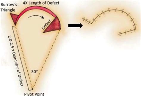 Rotation and transposition flaps in facial plastic and reconstructive surgery