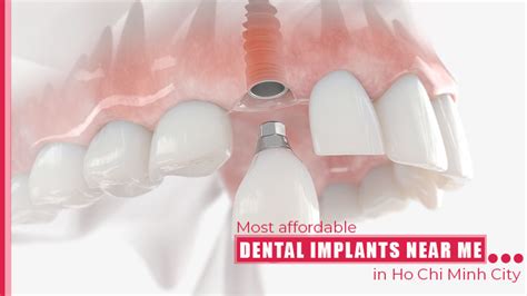 Most affordable dental implants near me in Ho Chi Minh City, Vietnam - Saigon Implant Dental ...