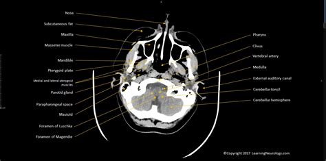 Approach to CT head | LearningNeurology.com