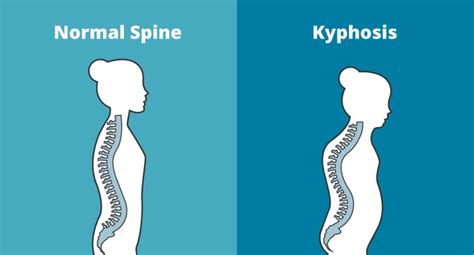 Massage and Kyphosis (Humpback) | Lumina Massage Inc.