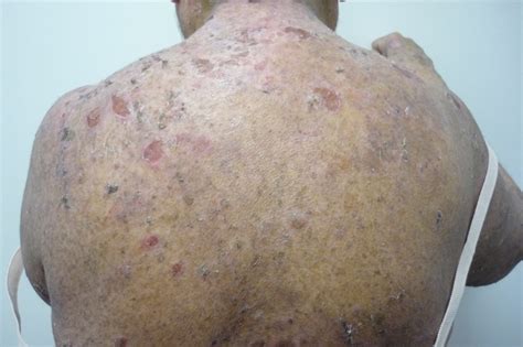 ACD A-Z of Skin - Pemphigus foliaceus