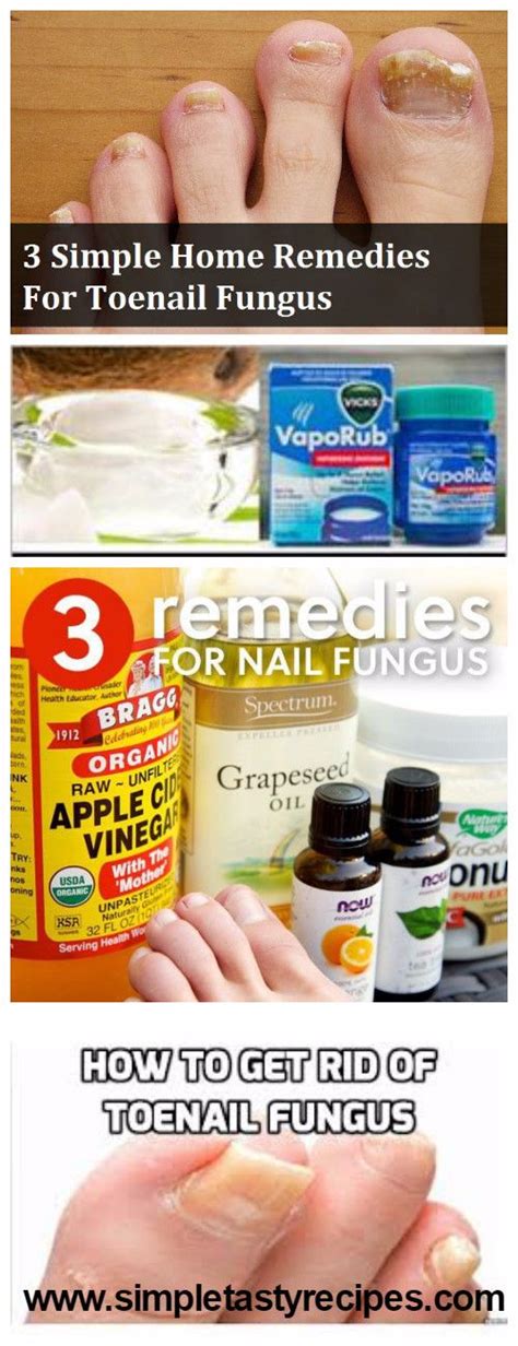 3 SIMPLE HOME REMEDIES FOR TOENAIL FUNGUS | HEALTH BLOG