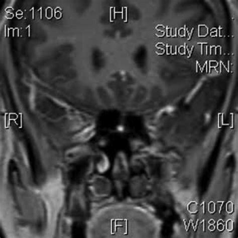 Pituitary tuberculoma with subsequent drug-resistant tuberculous lymphadenopathy: an uncommon ...