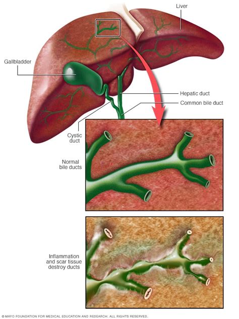 Primary biliary cholangitis - Symptoms and causes - Mayo Clinic