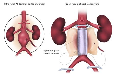 Open Aortic Surgery for Aneurysms - Dubai - Dr. Ahmed Farah