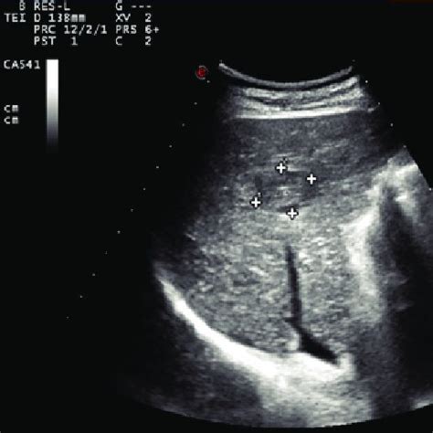 Contrast-enhanced ultrasound image for small hepatocellular carcinoma ...