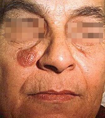 Granuloma Faciale: Background, Pathophysiology, Etiology