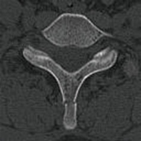 Spine Trauma - The Operative Review Of Surgery